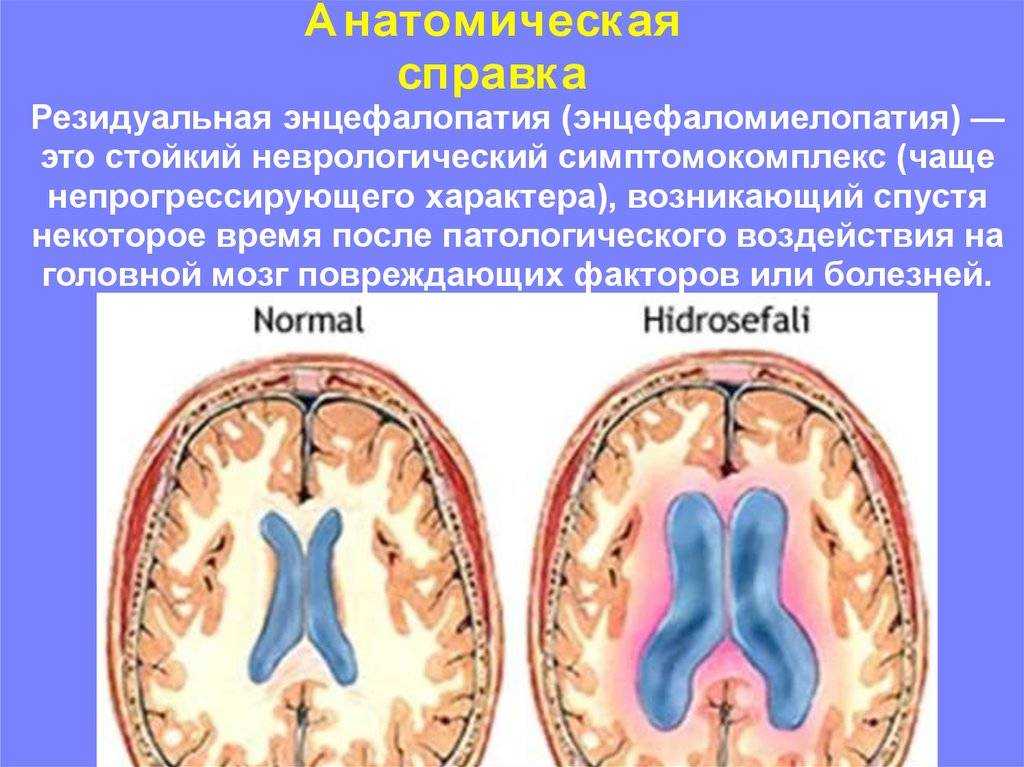 Энцефалопатия головного мозга: симптомы и лечение