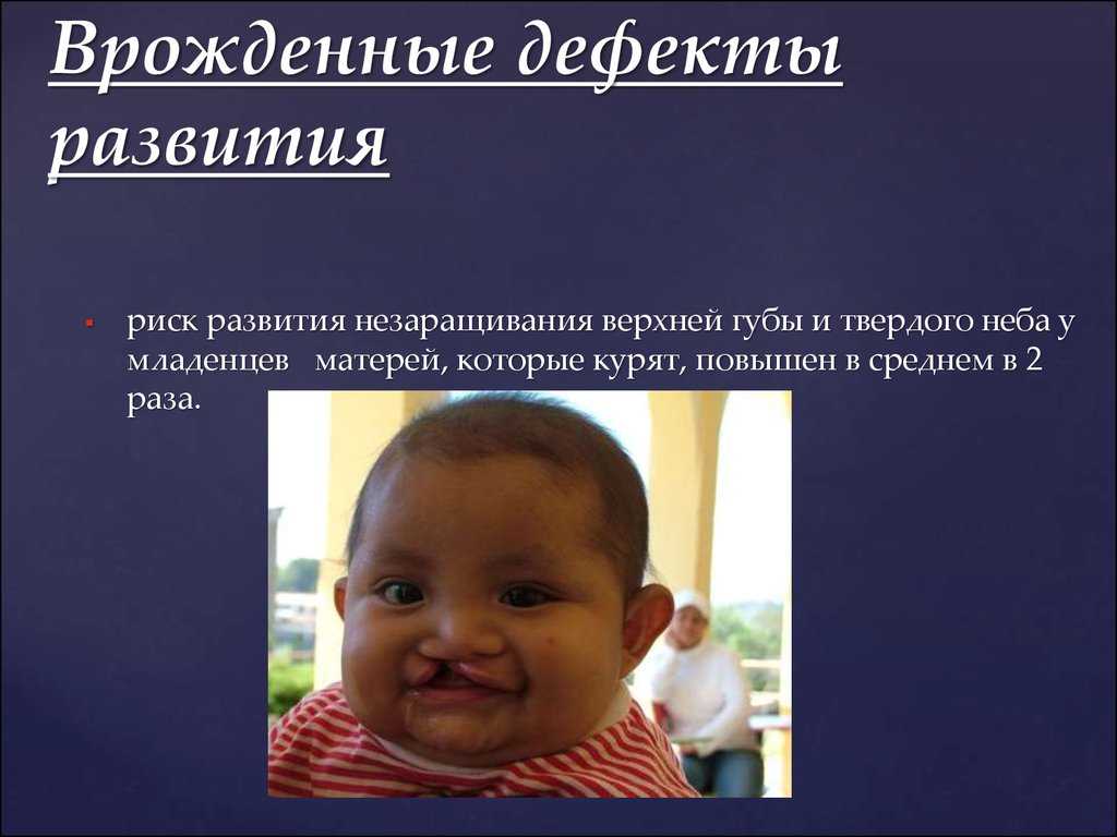 Гастрошизис: причины, симптомы и лечение в статье детского хирурга вавилов а. с.