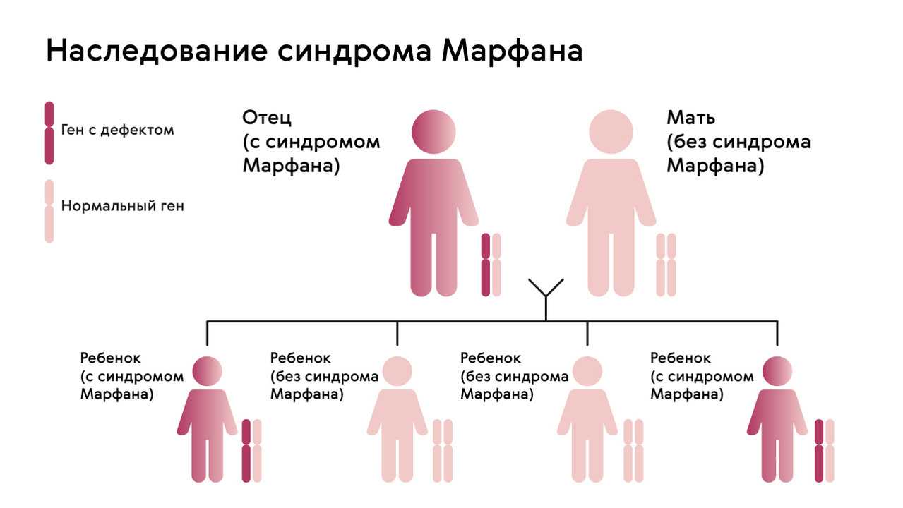Синдром марфана | симптомы | диагностика | лечение - docdoc.ru