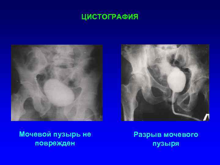 Пузырно-мочеточниковый рефлюкс у детей (пмр)  лечение, диагностика, операции — николаев василий викторович
