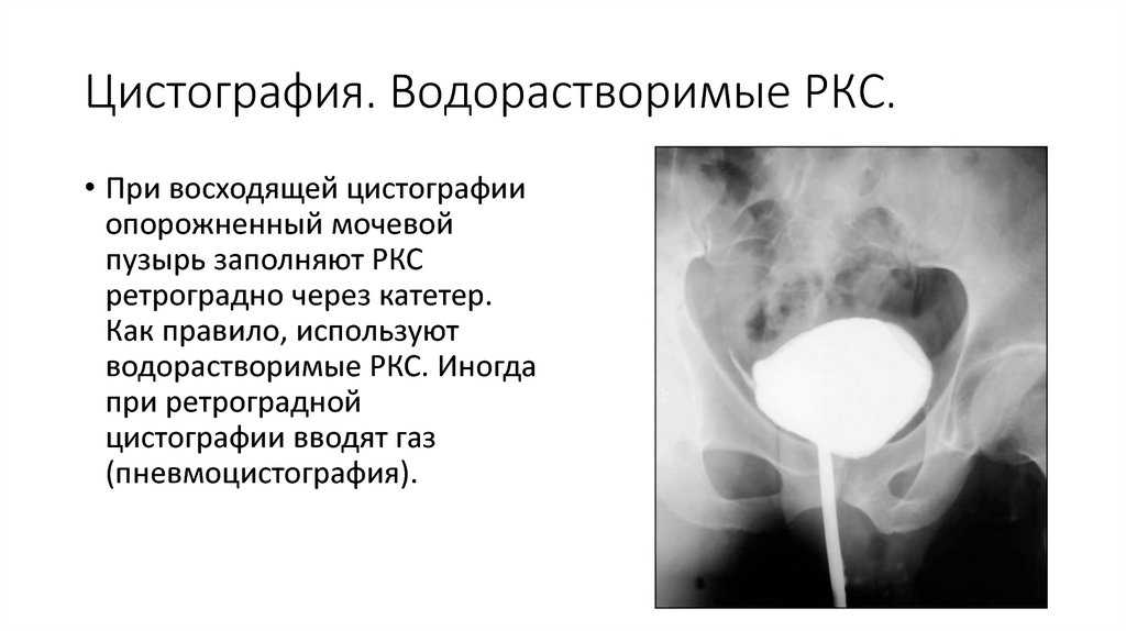 6 основных показаний для проведения цистографии у детей