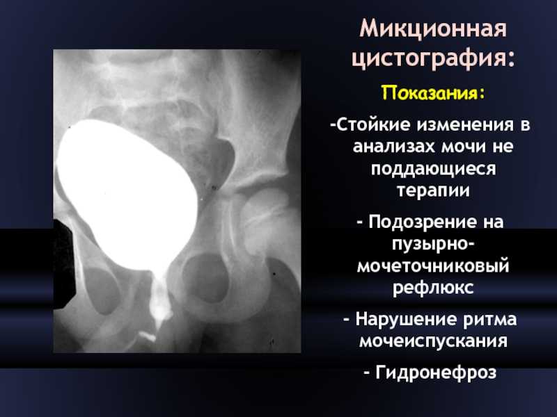 Пузырно-мочеточниковый рефлюкс
