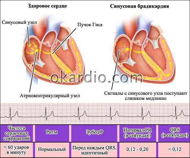 Аритмия сердца у детей